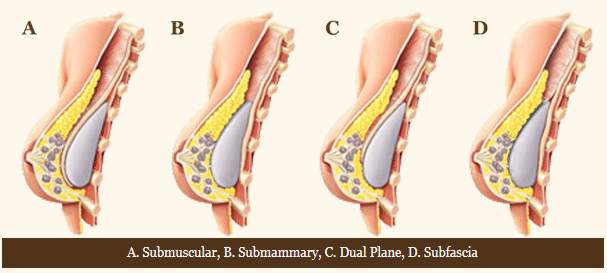 Breast surgery incisions - Submuscular, Submammary, Dual Plane, Subfascia