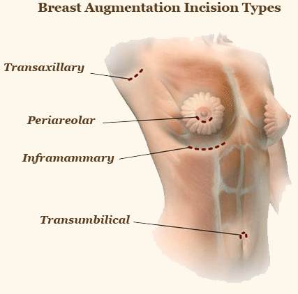 Breast enlargement surgery incision types